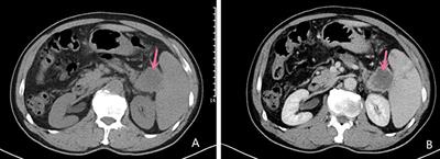 Management of Primary Squamous Cell Carcinoma of the Pancreas: A Case Report